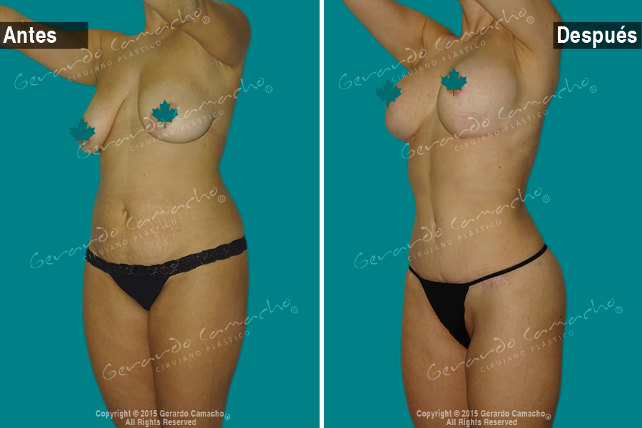  Mommy Makeover Colombia